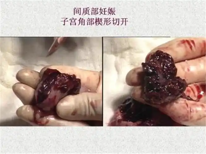 间质部宫外孕侧切图片
