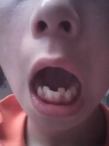 我的下牙不齐,整牙需要很多钱,还有下边的门牙旁边的两个牙齿是什么牙