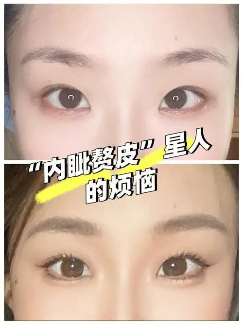 内眦赘皮眼距宽和开不开的内眼角00