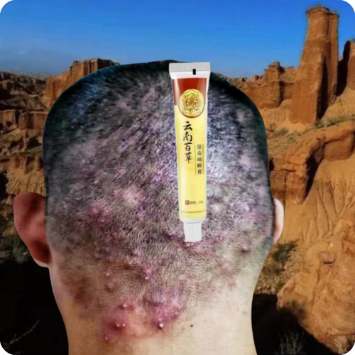 头皮长红疙瘩脓包痘痘头皮痒毛囊炎头上毛囊红肿起脓包后脑勺疙瘩