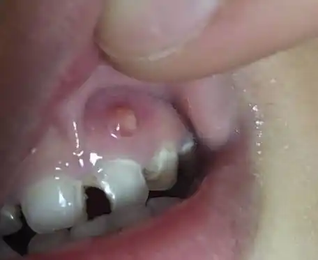 根尖周炎和牙髓炎有什么区别吗?