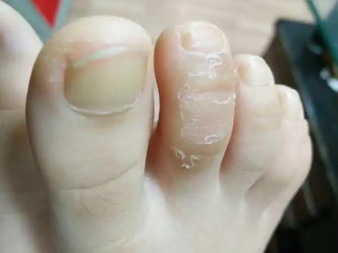 脚趾怎么还会脱皮.不疼不痒.脱皮的地方皮肤颜色很深.