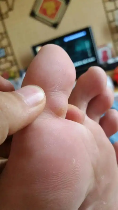 大脚趾这里长了一颗肉丁,碰到就痛,是不是鸡眼啊?