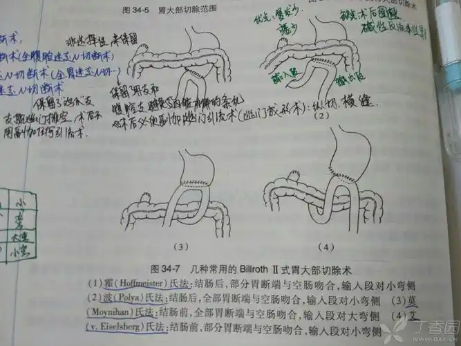 看不懂外科毕罗二式胃大部切除术手术方式