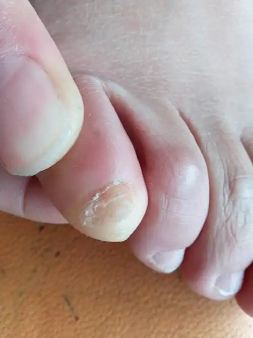 右脚小脚趾甲靠右边的皮变硬一大块,触摸时痛怎么回事