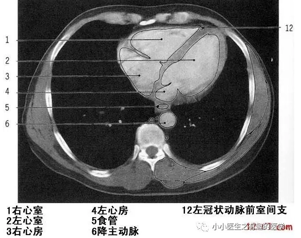 胸部ct解剖入门:如何用左右心室推理出全部纵膈结构?