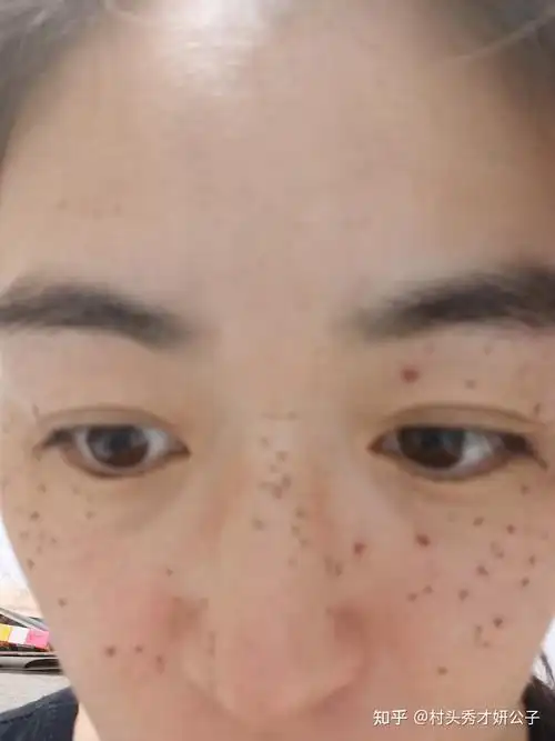 药水点斑记录过程