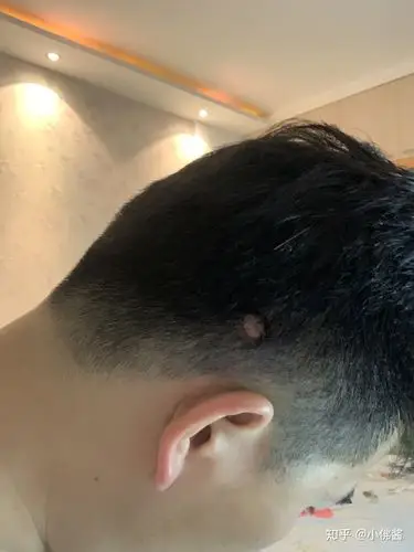 后脑勺长了一个肉疙瘩?