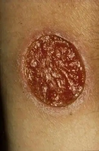 软下疳是梅毒吗软下疳是什么症状龟头软下疳是什么病龟头软下疳的症状