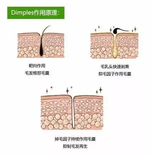 但能像dimples角化粗糙,毛囊发炎等不良后果将导致毛发变粗,内嵌毛