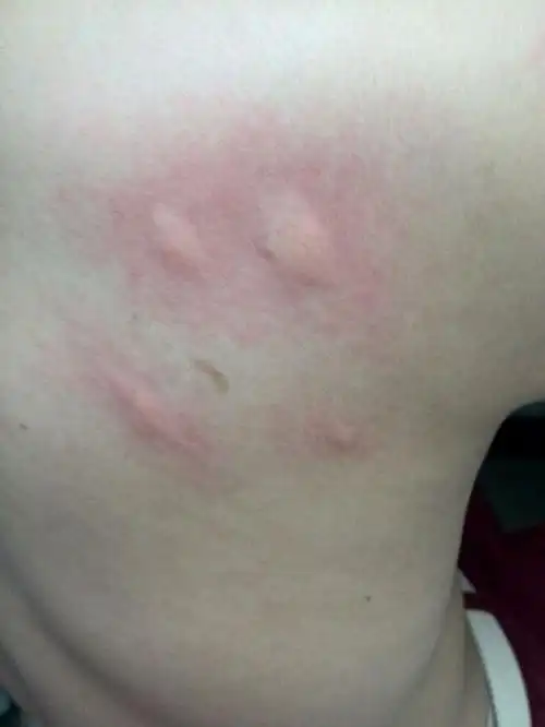 虫咬性皮炎敏症状图片_有来医生