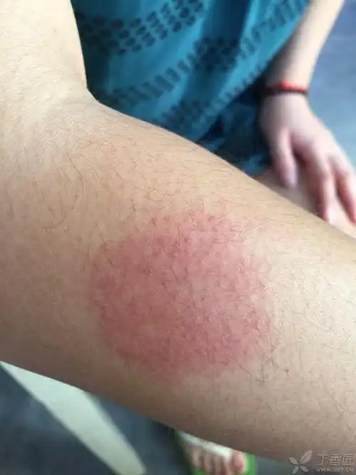 圆形红斑伴瘙痒 [病例帖]