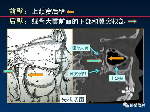 【柳澄讲坛】"翼腭窝解剖"--msct