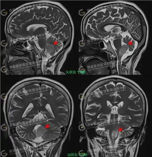 男,52岁,外院ct发现第四脑室高密度占位9年余.