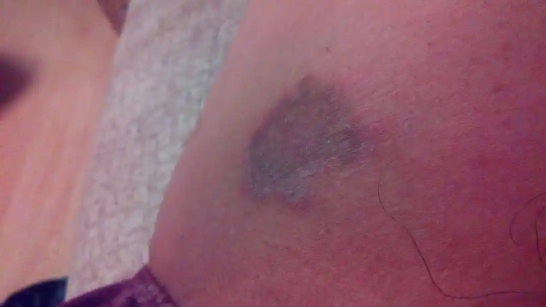 大腿内侧不知什么时候开始有点痒,发现成这样子了,而且月挠越有点大,