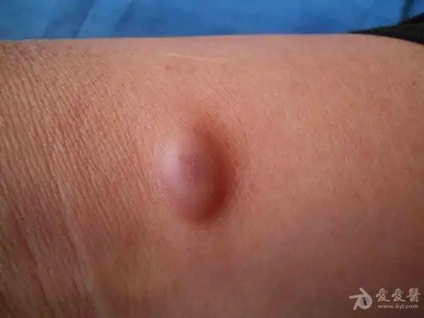 猜☆图☆病☆例☆(48)答案:皮肤纤维瘤,前5名加密回答准确均已加分.