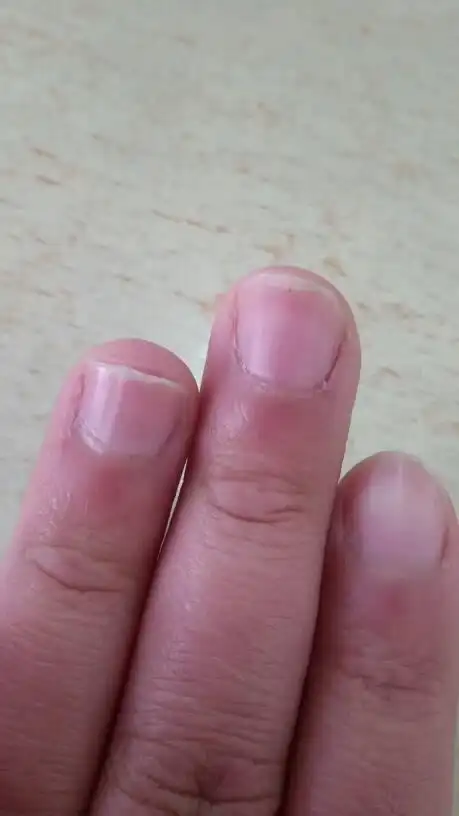 指甲上有竖纹 怎么回事 求解答