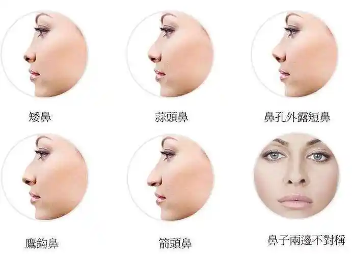 肋软骨隆鼻失败多久能修复?