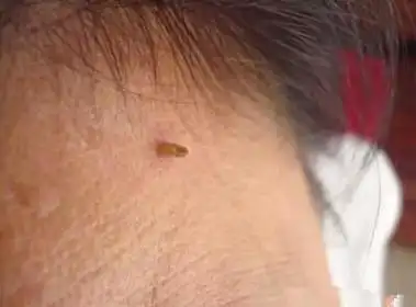 皮肤上的皮赘物