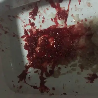 我怀孕三个月,前天晚上吐的厉害,吐到最后吐血了.会影响宝宝吗?