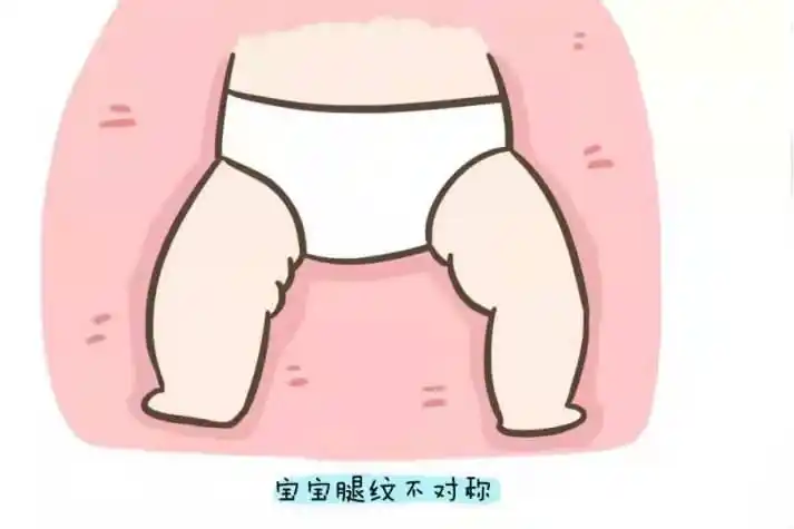 什么是腿纹不对称?