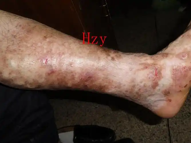 左小肢的皮肤病