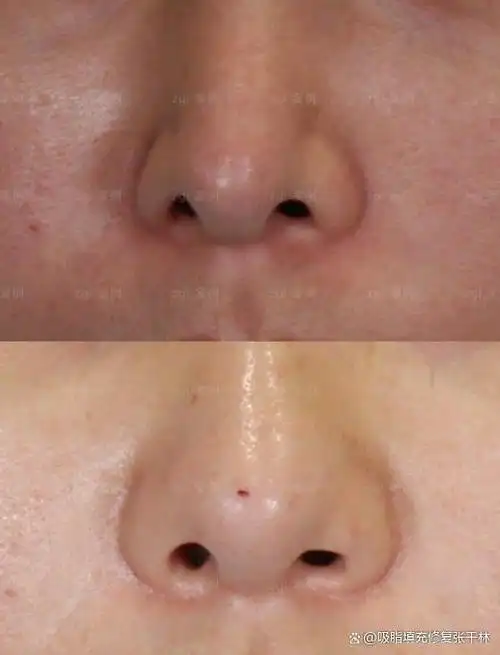 鼻翼缘缺损 脂肪填充 鼻翼缘退缩