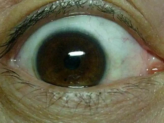 青光眼的早期症状图片_有来医生