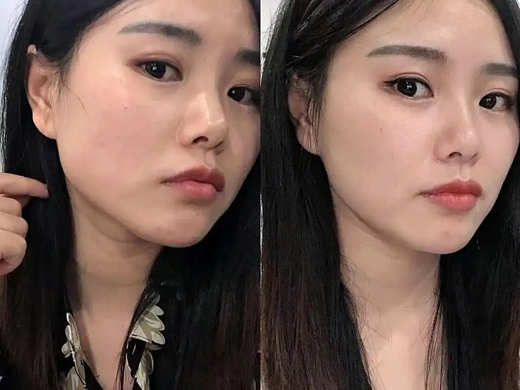 第一次打瘦脸针,对比是很明显的,打的国产衡