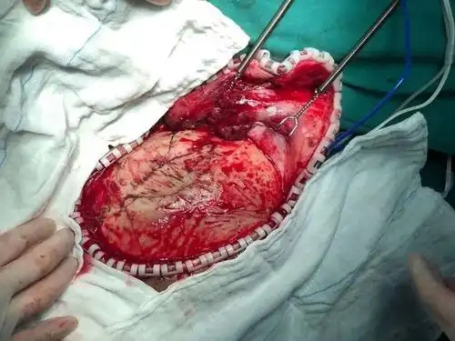 手术指征明确,积极完善术前准备,急诊在全麻插管下行左侧开颅探查