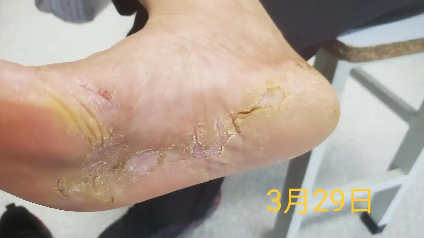 中医药攻克难治性手足湿疹的一个病例