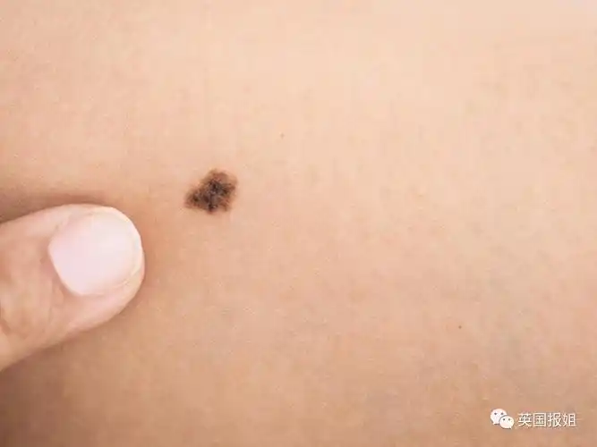 然而,黑色素瘤通常具有以下特征:1.形状不规则,比如非常不对称的痣2.