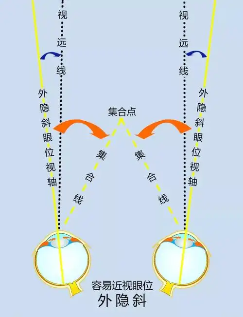 9 外隐斜眼位的孩子 眼位外隐斜较大,看近看远均处于视轴向内转的状态