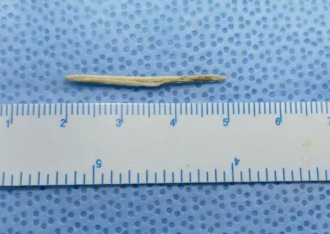 3厘米鱼骨刺穿胃壁刺入胰腺数字导航技术助力取鱼刺