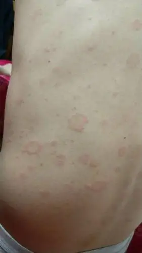 身上出现很多红印,一天比一天多,不痛不痒