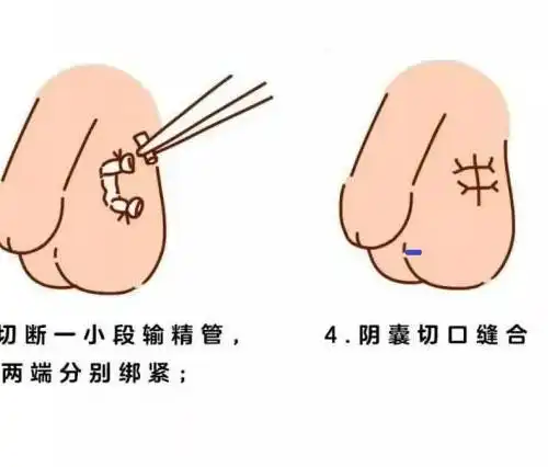 【新协和百科】男性结扎后还会射精吗?