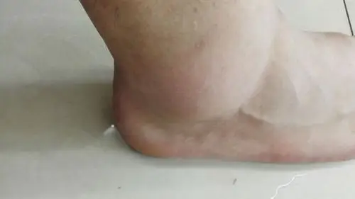 打篮球脚踝扭伤了,照了片,请帮我看看好吗