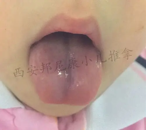 小儿舌诊临床案例—舌中间有个沟是怎么回事?