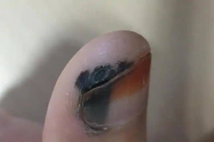 哪种指甲黑线代表癌症图片