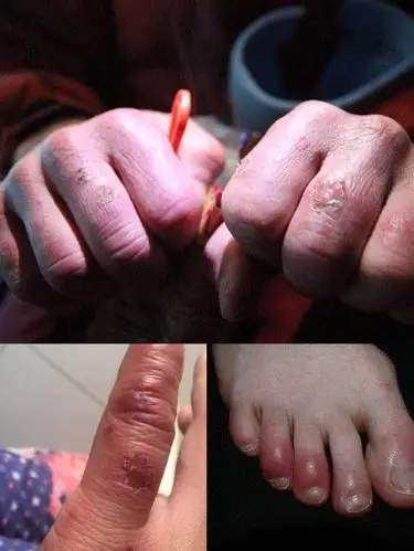 治疗冻疮只要一味药,不服不行.