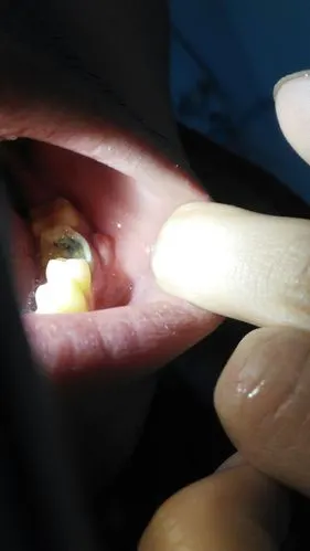 腮部,我的口腔内长了好大一个肉瘤,有乳头,乳头破会淌少量的血,医生