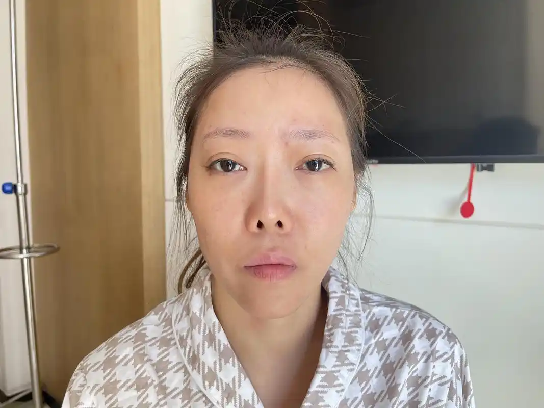 露鼻孔 朝天鼻的39岁求美者,7天前来北京修复鼻子,术后这样?
