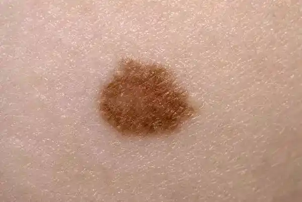 【恶性黑色素瘤图片】_症状_危害_苹果绿