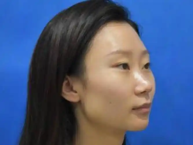 术前诊断低山根低鼻尖鼻翼肥,鼻头比较翘小,没有立体_圈子-新氧美容