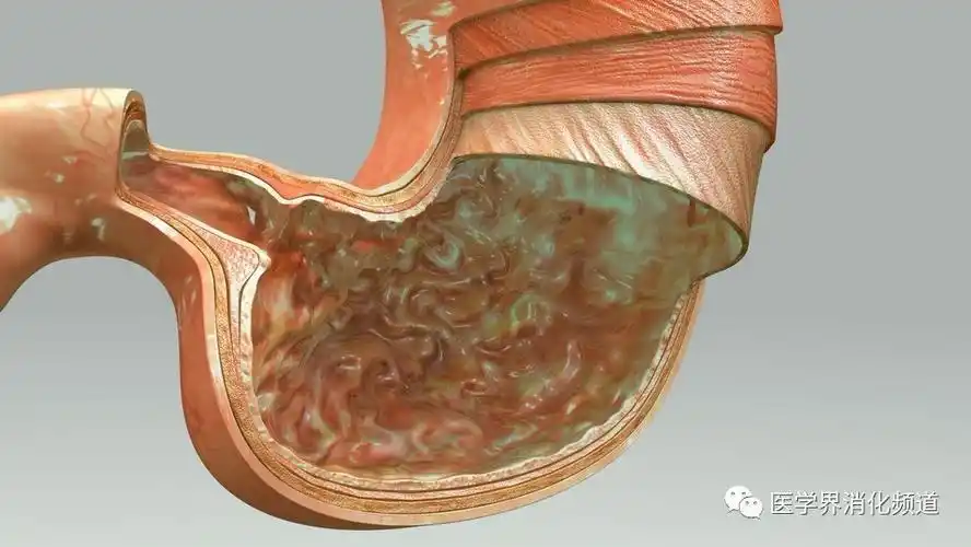 "肠化生"就一定会变成胃癌吗?幼稚!
