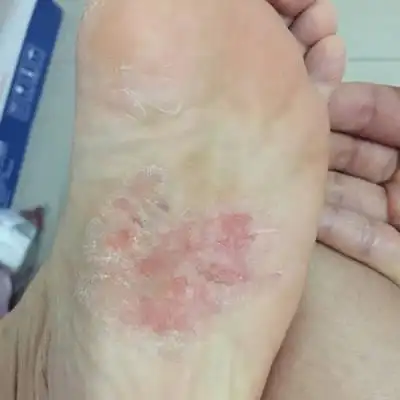 脚心长水泡又痒怀孕了可以用什麼药吗?难受