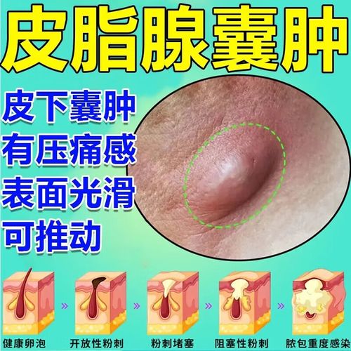皮脂腺囊肿药膏莫匹罗星软膏治皮脂腺囊肿粉瘤痘痘去除膏消皮下脓包火