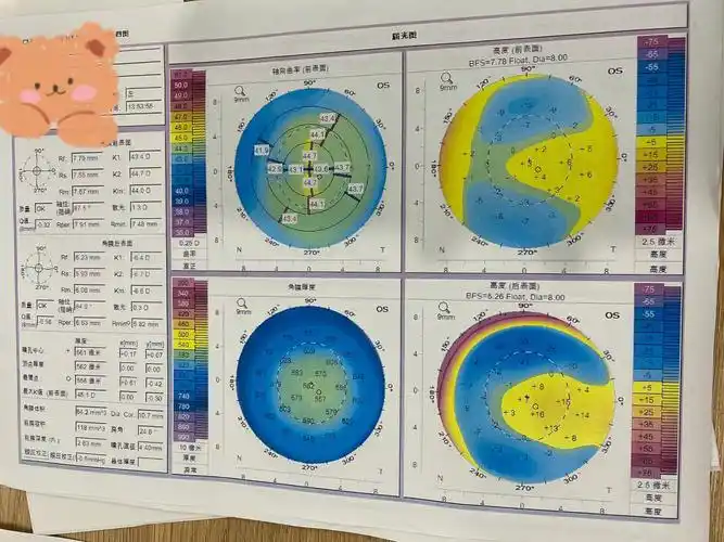 角膜地形图不好可以做smart吗