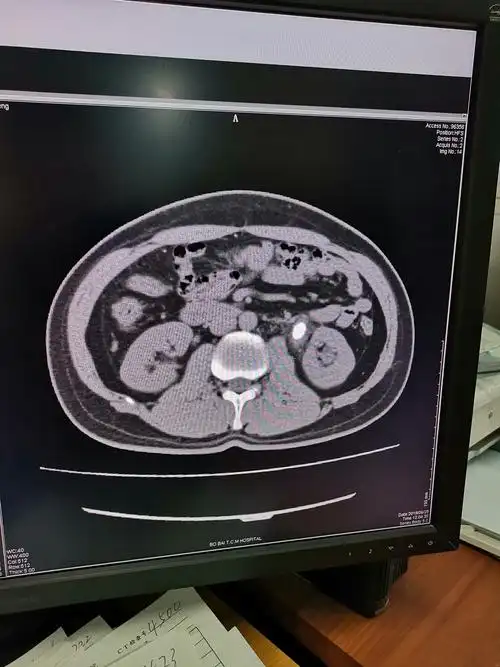 左输尿管上段结石