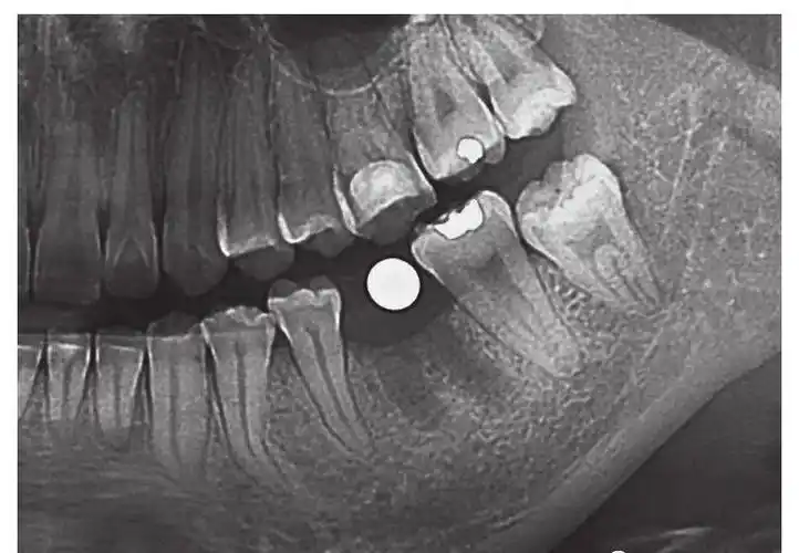 图8-1术前全景片